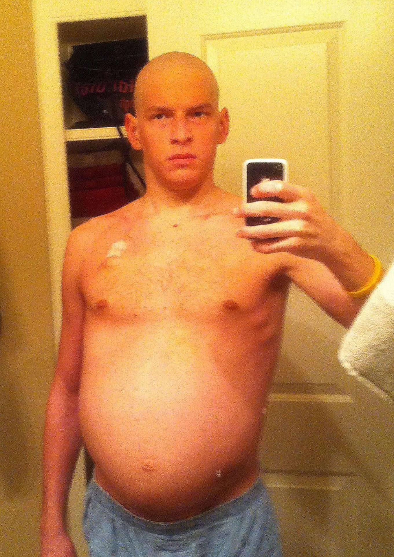 In this picture from 2011, David Fajgenbaum shows off his distended stomach, caused by the failure of his liver and kidneys.