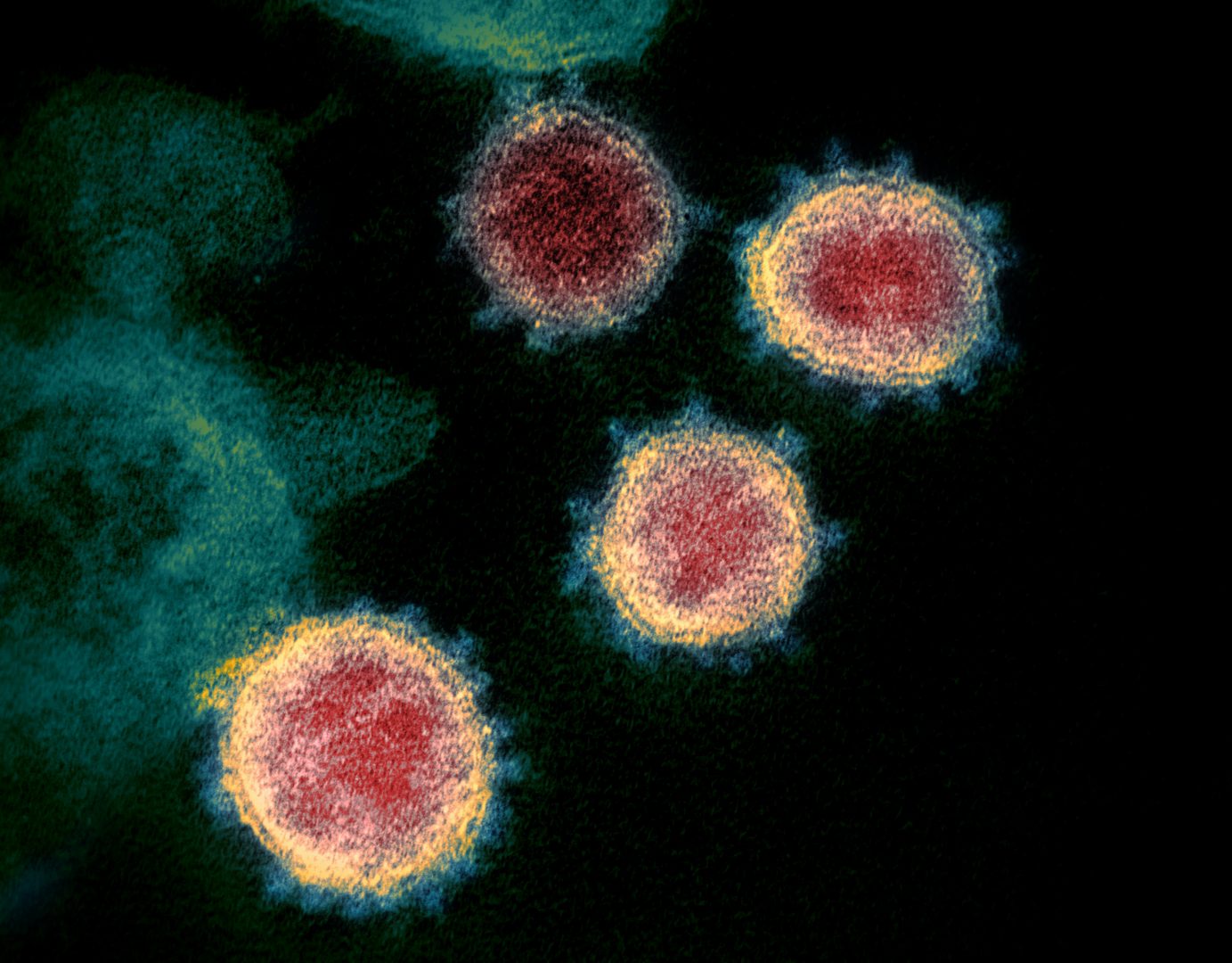 This undated electron microscope image made available by the U.S. National Institutes of Health in February 2020 shows the virus that causes COVID-19. The sample was isolated from a patient in the U.S. Excitement about treating the new coronavirus with malaria drugs is raising hopes, but the evidence that they may help is thin. (NIAID-RML via AP)