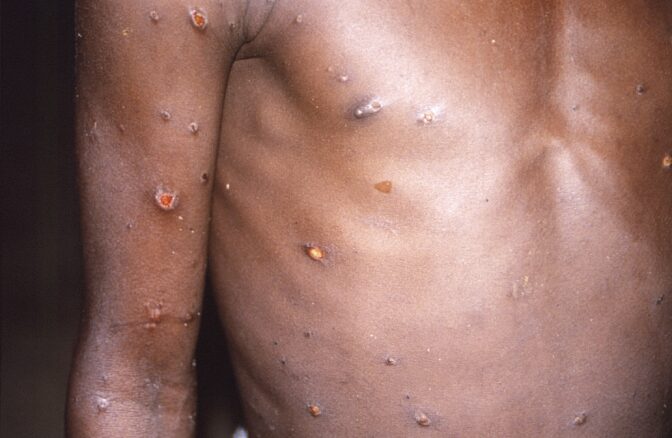 This 1997 image provided by U.S. Centers for Disease Control and Prevention shows the right arm and torso of a patient, whose skin displayed a number of lesions due to what had been an active case of monkeypox.